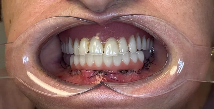 Rezultat tratament stomatologic complex Denteca Smile Clinic București