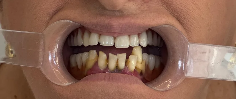 Caz clinic înainte: dinți afectați, carii, nevoie de tratament stomatologic