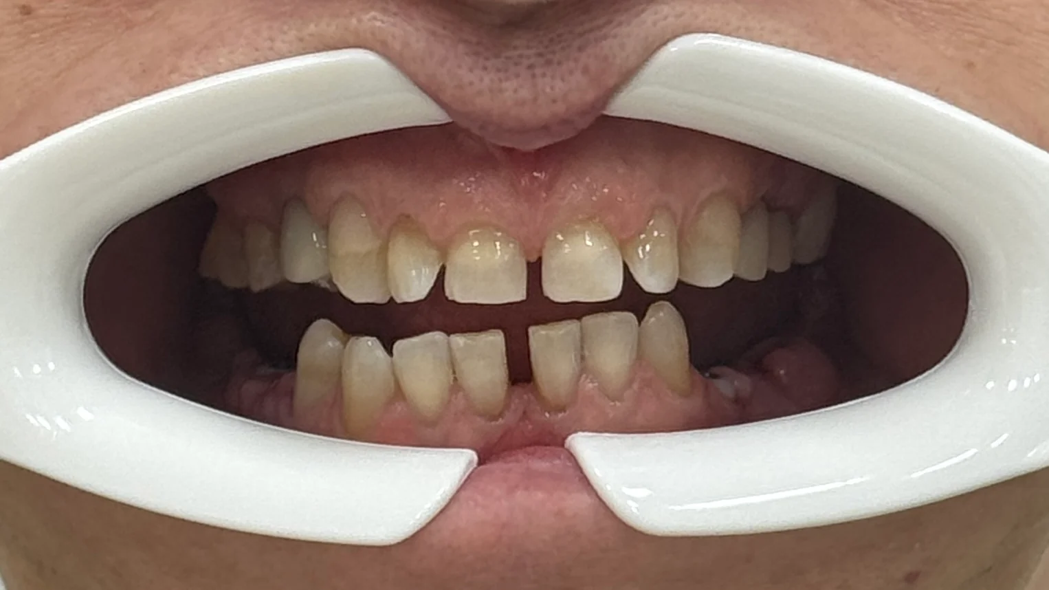 Caz clinic Denteca Smile Clinic: dinți îngălbeniți, spații interdentare