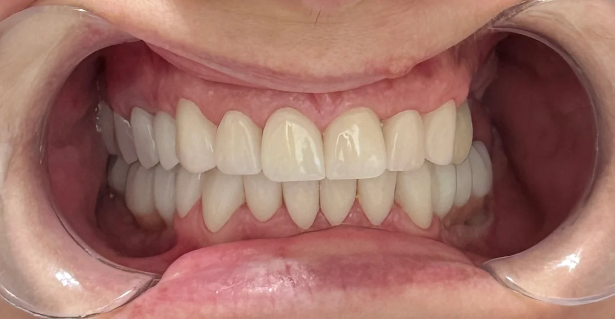 Caz clinic final: zâmbet perfect obținut la Denteca Smile Clinic