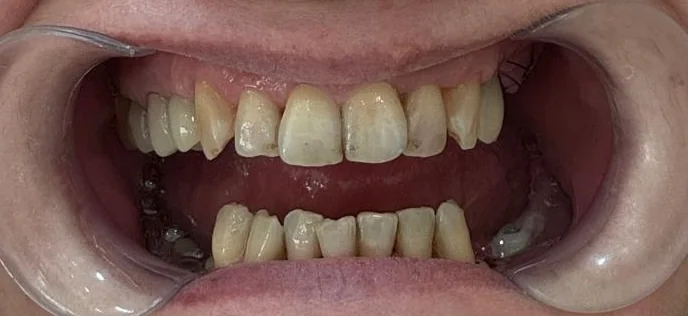 Caz clinic înainte de tratament stomatologic la Denteca Smile Clinic