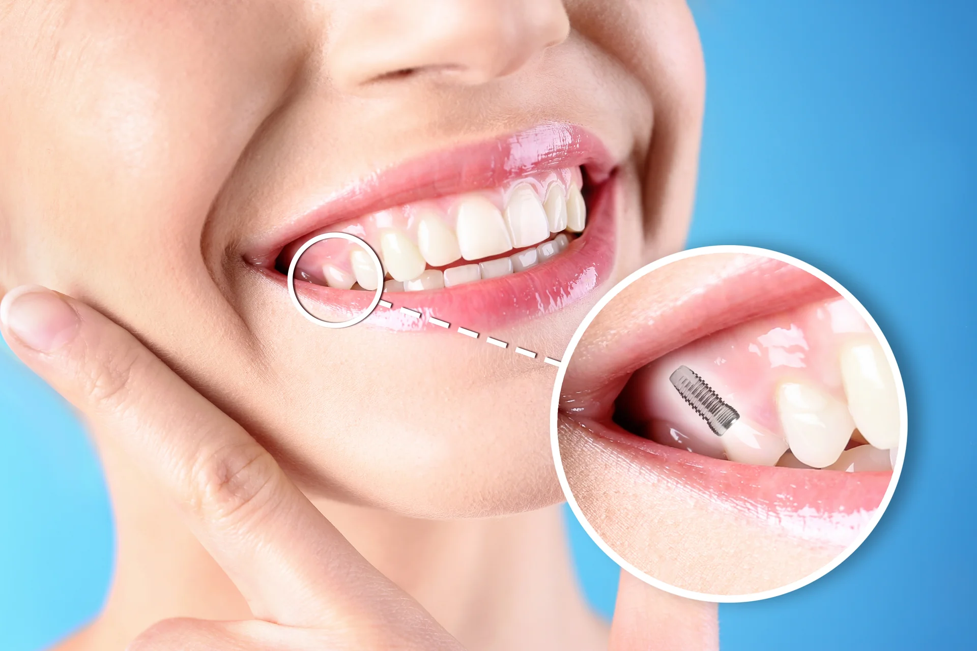 Coroană pe implant vs coroană pe dinte natural: diferențe și indicații