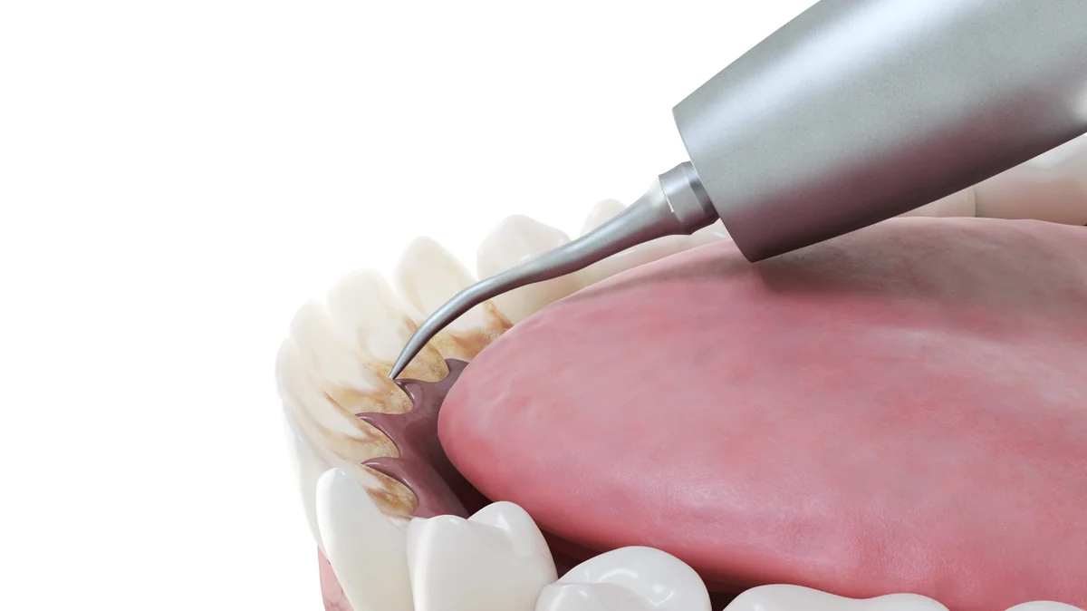 Detartraj profesional la Denteca Smile Clinic, București, pentru dinți sănătoși