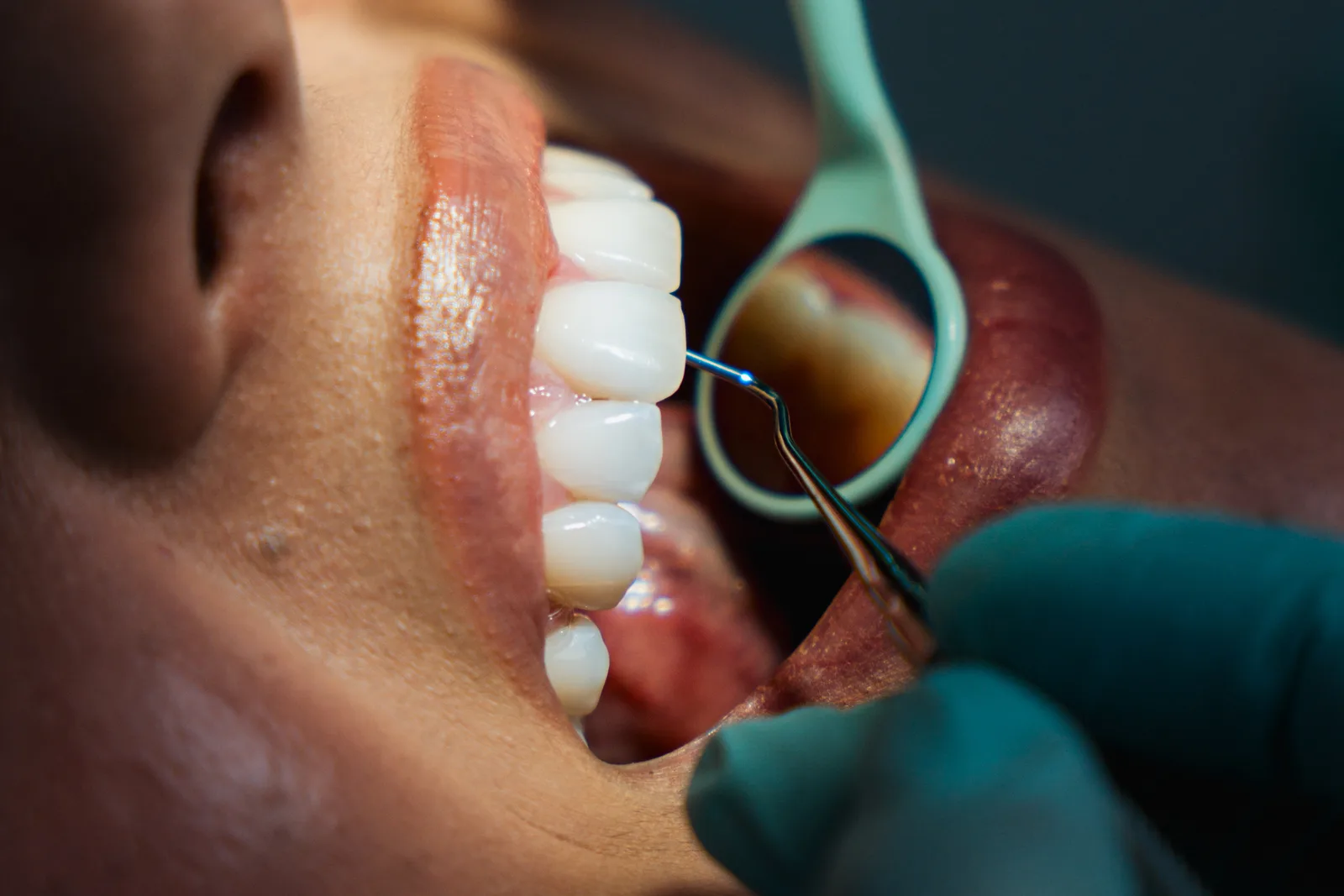 Fațete dentare ceramice Emax - control în cabinet, Denteca Smile Clinic Fațete dentare ceramice Emax verificate cu oglinda și sonda stomatologică la Denteca Smile Clinic București