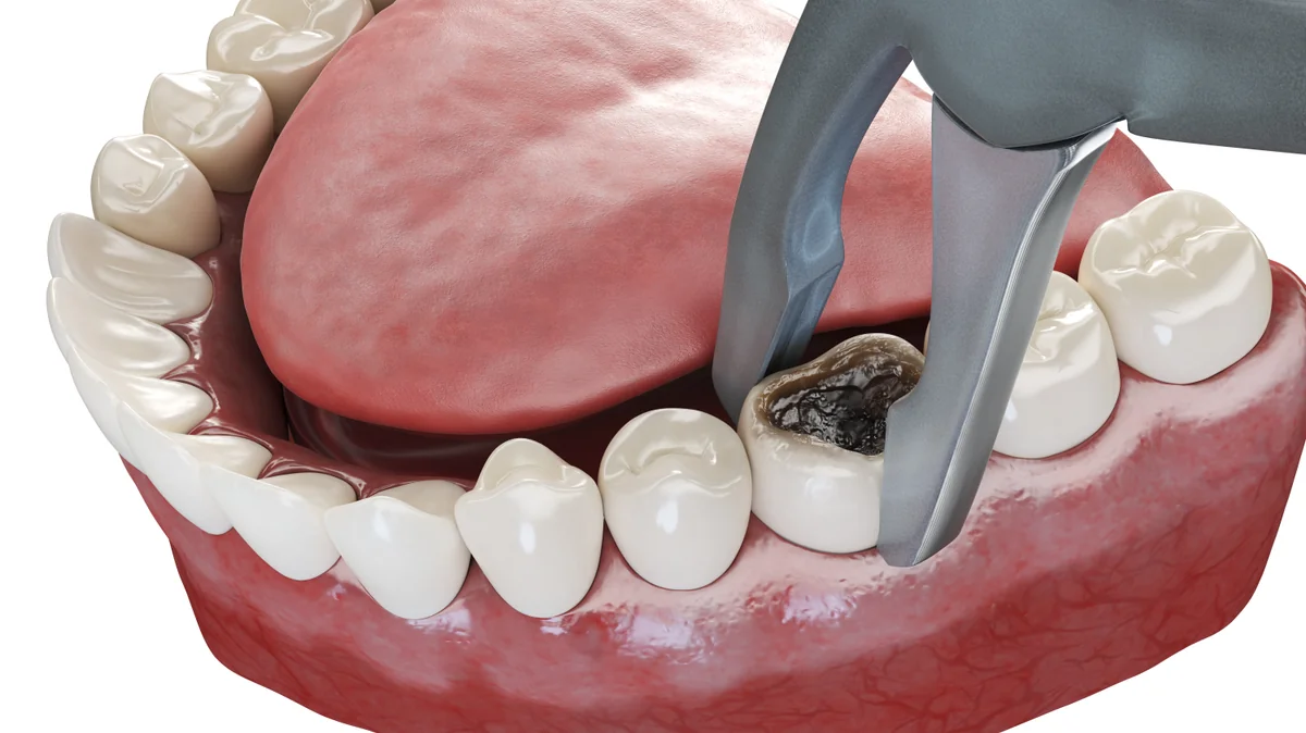 Extracție dentară - Denteca Smile Clinic Extracție dentară la Denteca Smile Clinic din București