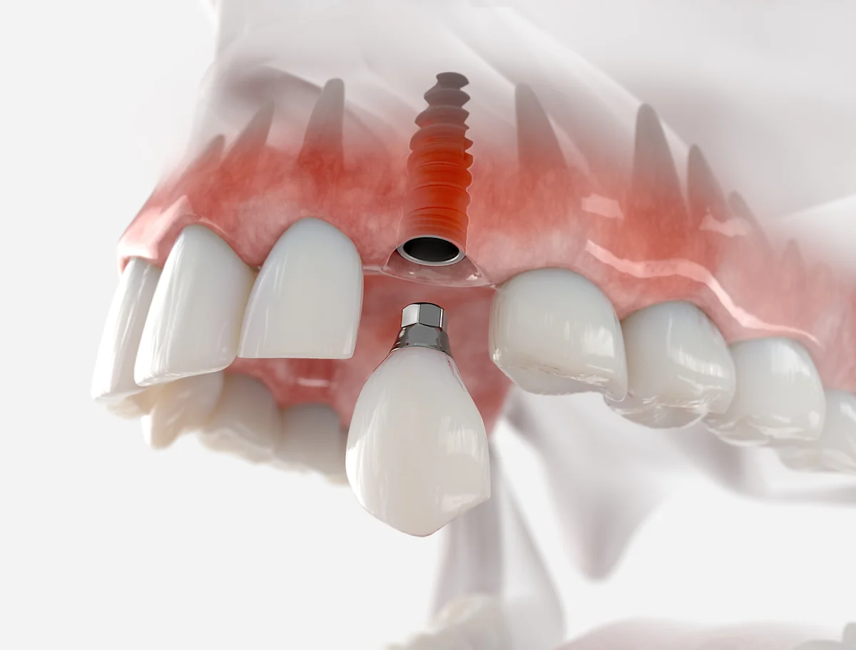 Componente implant dentar: bont, coroană, șurub - Clinica Denteca București
