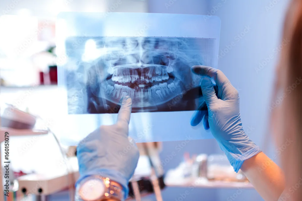 Radiografie panoramică Denteca Smile Clinic Radiografie panoramică dentară pentru diagnosticare precisă la Denteca București