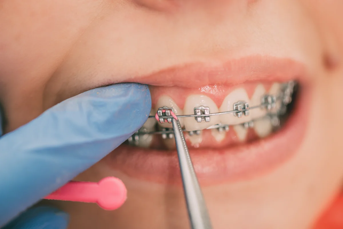 Schimbare elastic aparat dentar la Denteca Smile Clinic București