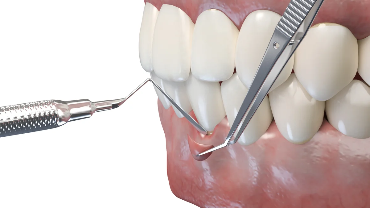 Sondare parodontală - Denteca București Sondare pungă parodontală, diagnostic parodontită la Denteca Smile Clinic