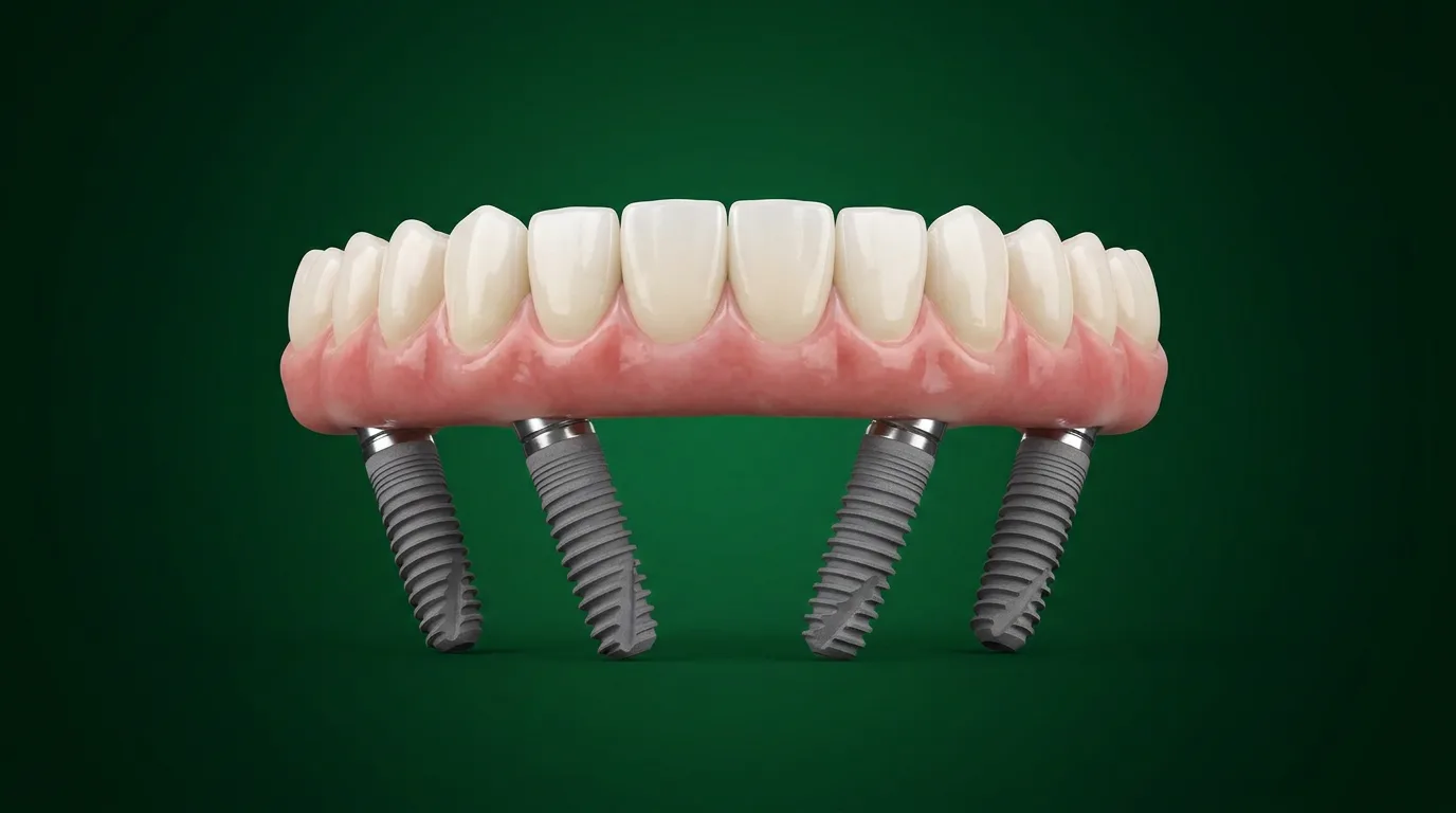 All-on-4 Straumann BLX - Denteca Smile Clinic Randare dantură fixă pe 4 implanturi Straumann (All-on-4) - Denteca Smile Clinic