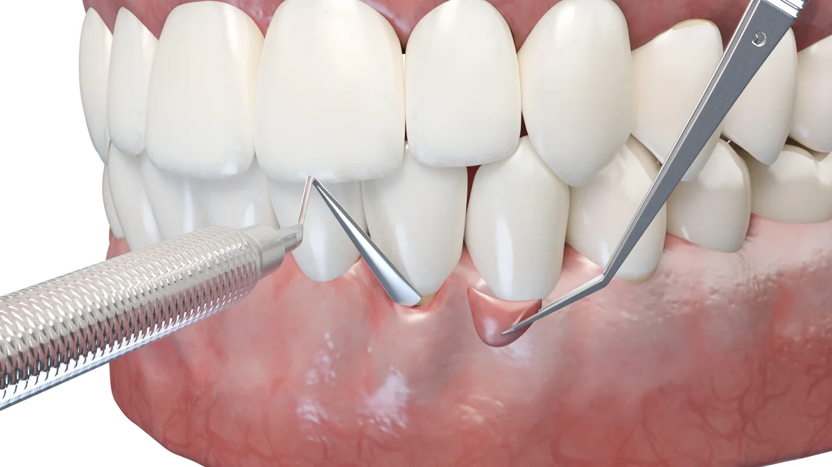 Tratament parodontal Denteca Smile Clinic Tratament parodontal profesional la Denteca Smile Clinic din București